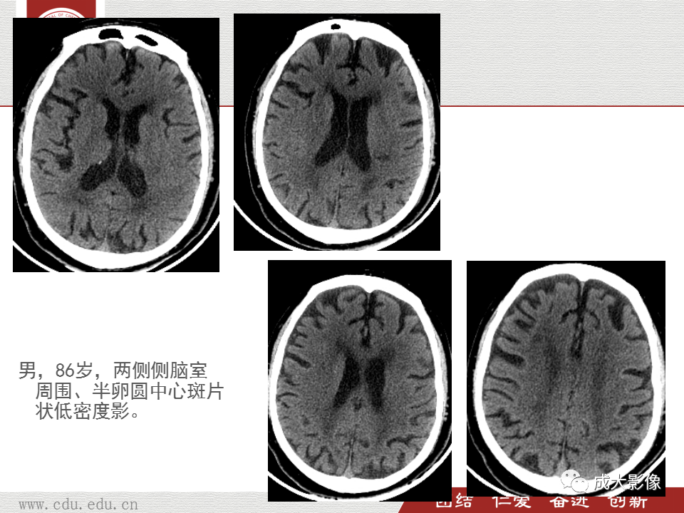 【PPT】脑白质疏松症-10