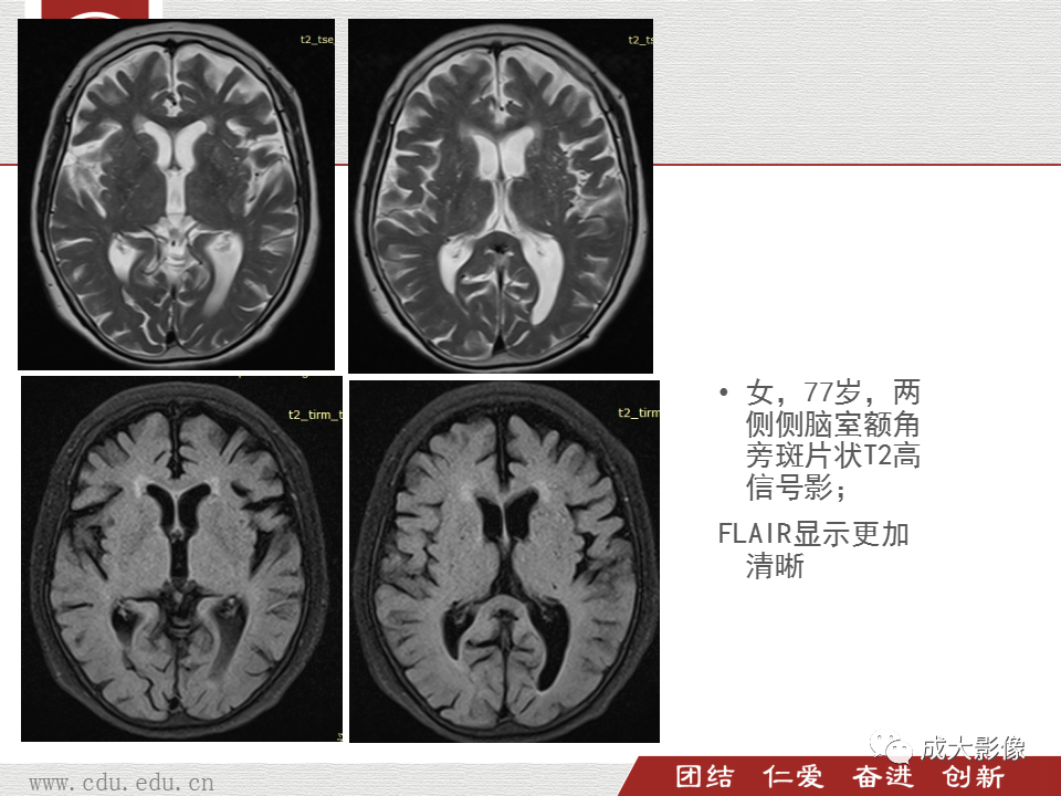 【PPT】脑白质疏松症-12