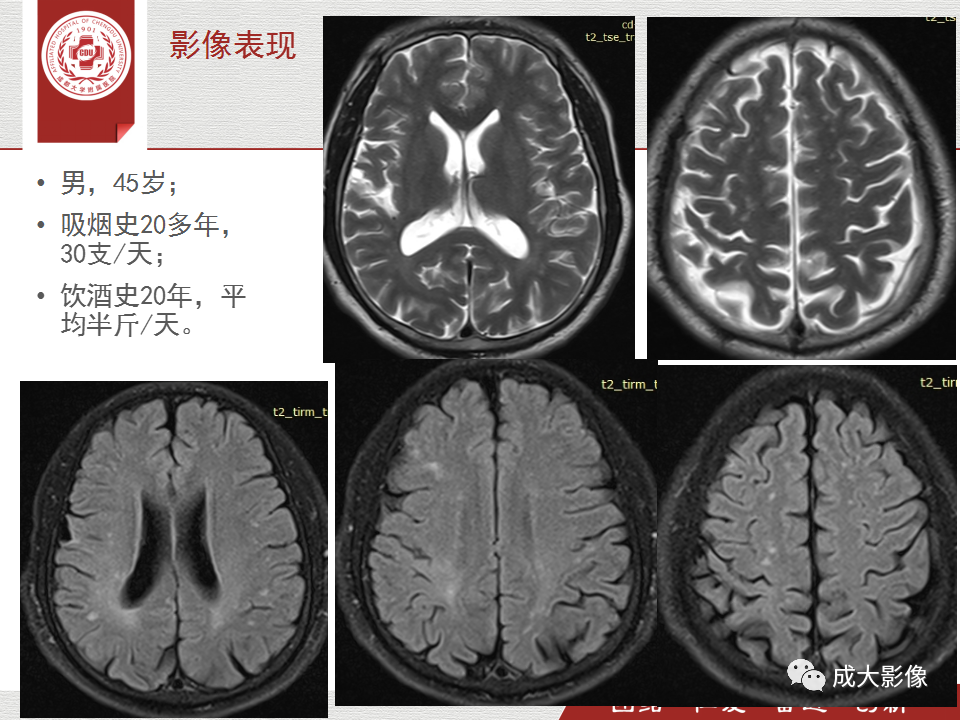 【PPT】脑白质疏松症-13