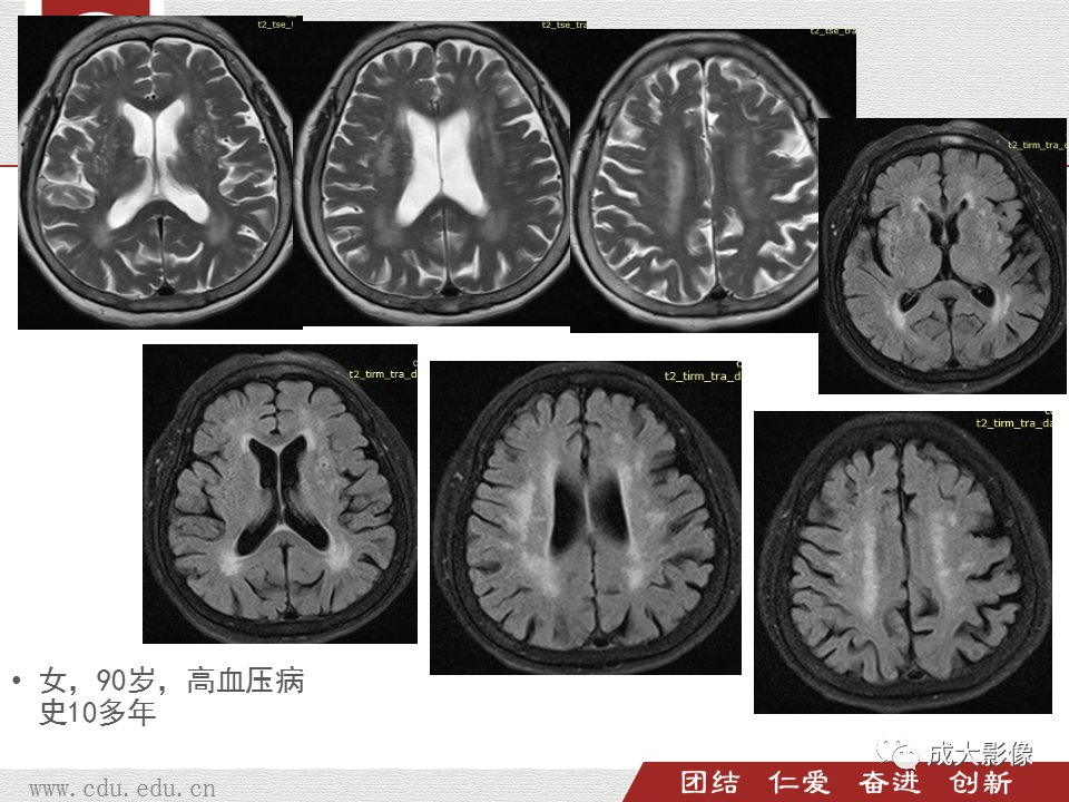 【PPT】脑白质疏松症-14