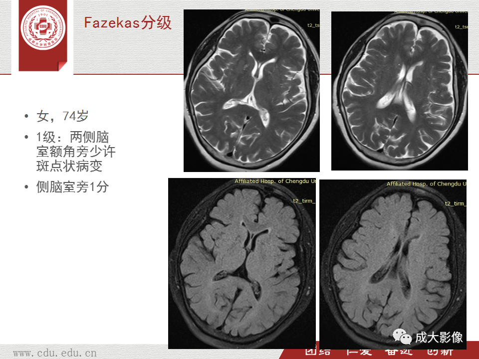【PPT】脑白质疏松症-19