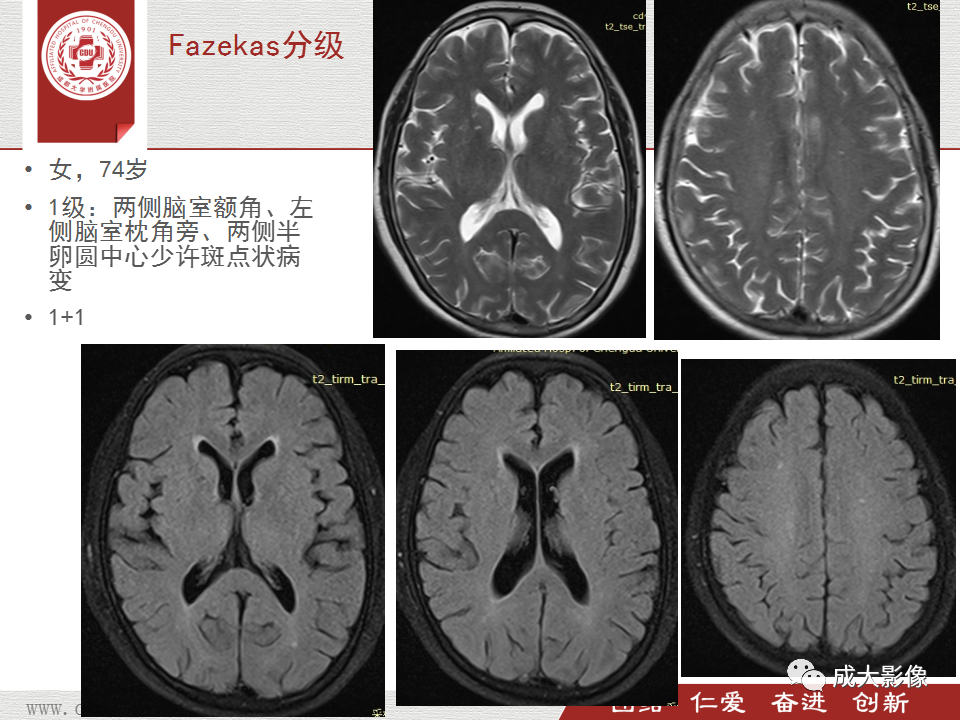 【PPT】脑白质疏松症-20