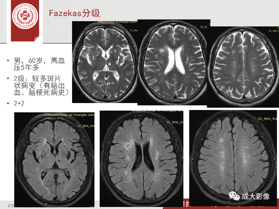 【PPT】脑白质疏松症-21