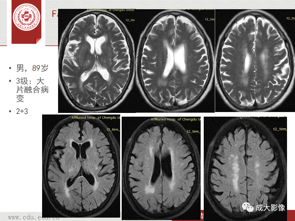 【PPT】脑白质疏松症-22