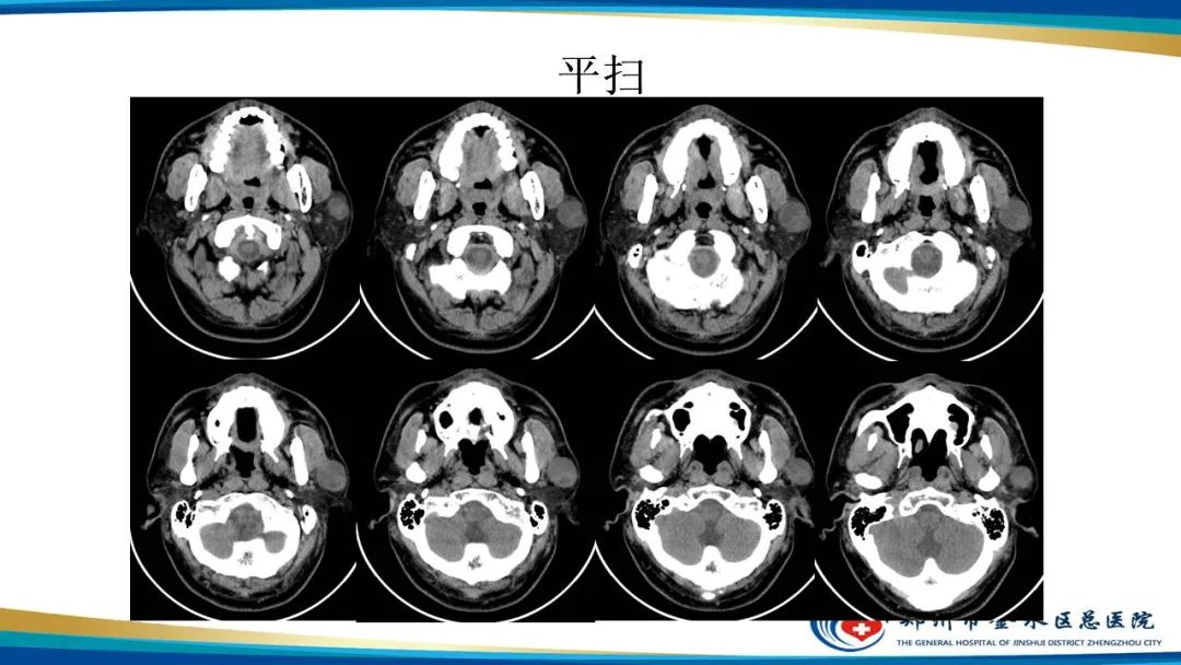 【病例】腮腺多形性腺瘤1例CT影像-4