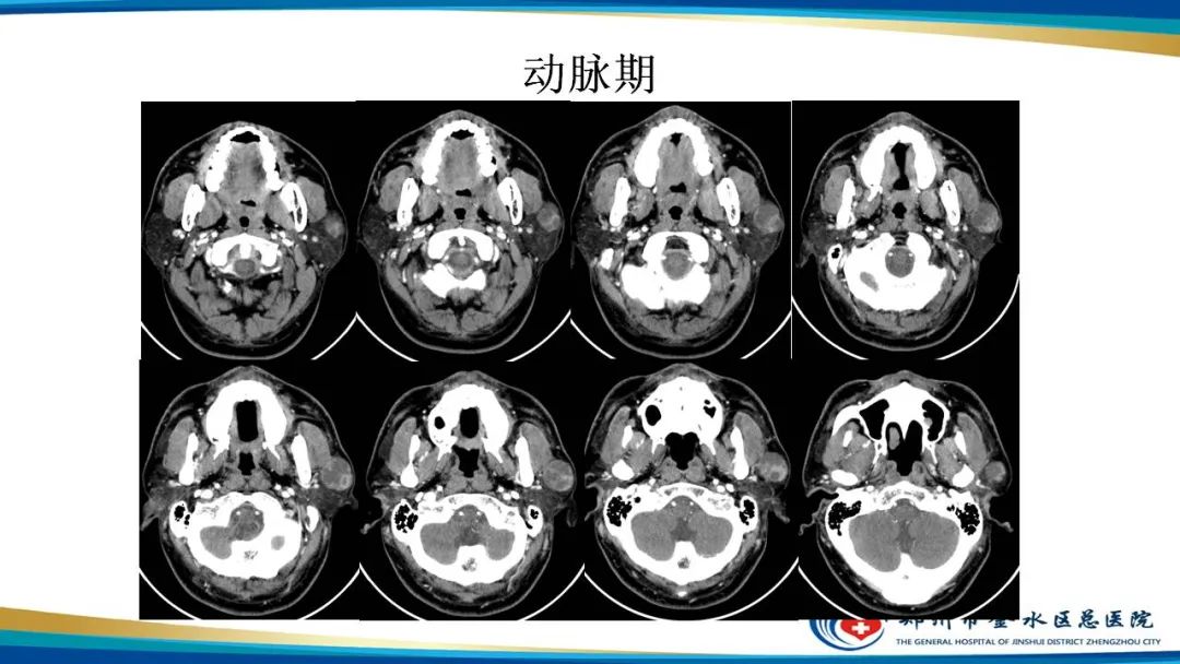 【病例】腮腺多形性腺瘤1例CT影像-5