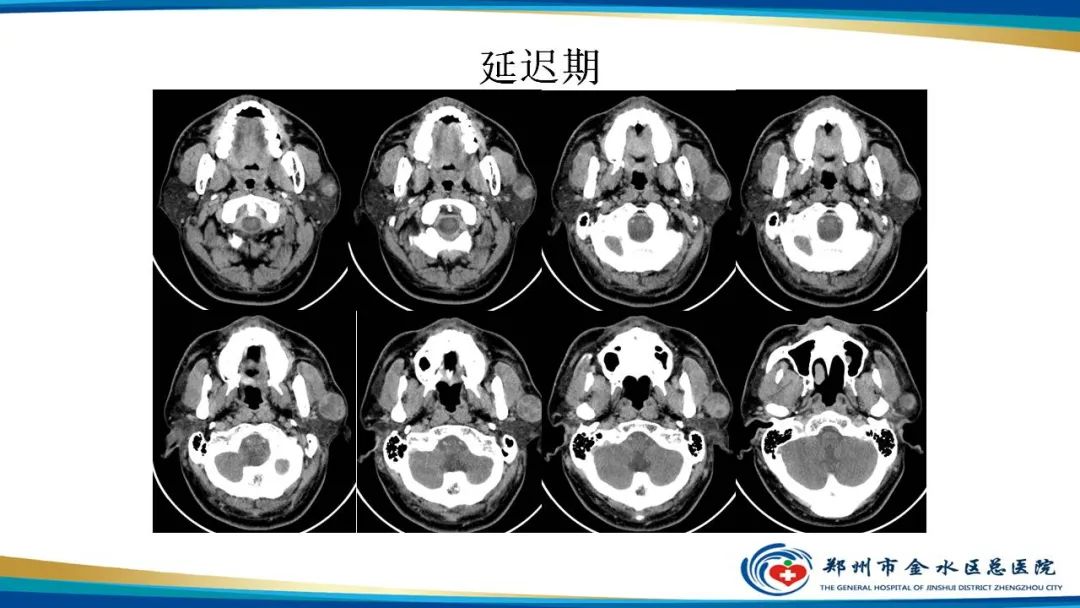 【病例】腮腺多形性腺瘤1例CT影像-7