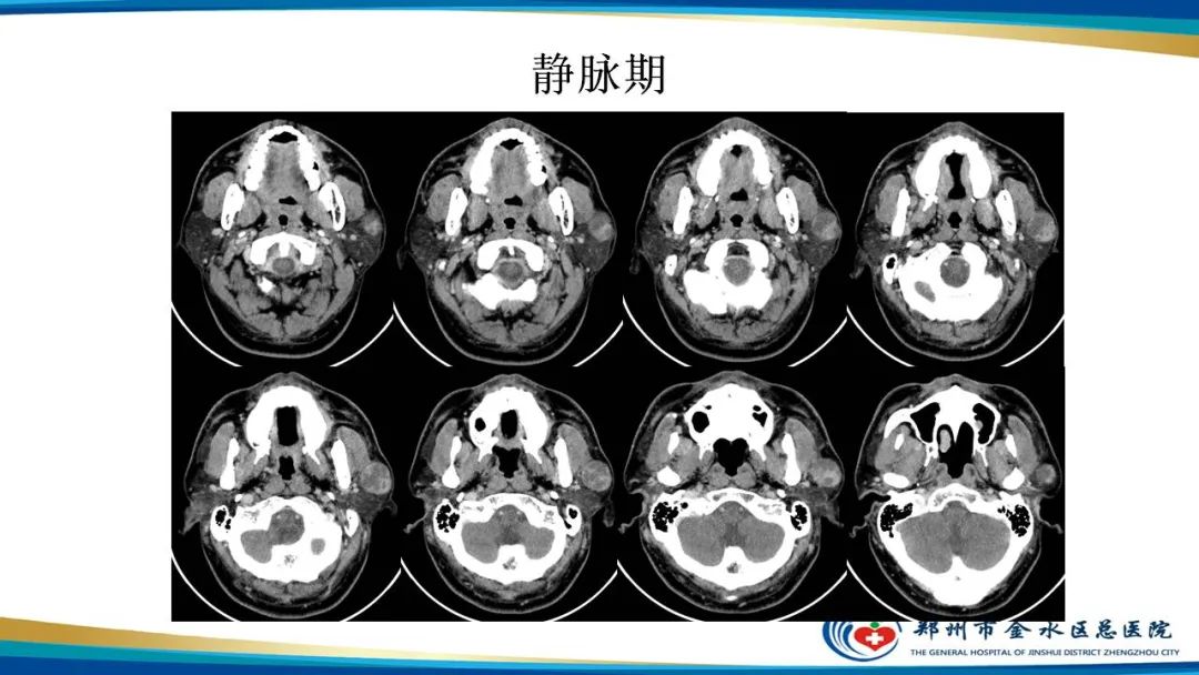 【病例】腮腺多形性腺瘤1例CT影像-6