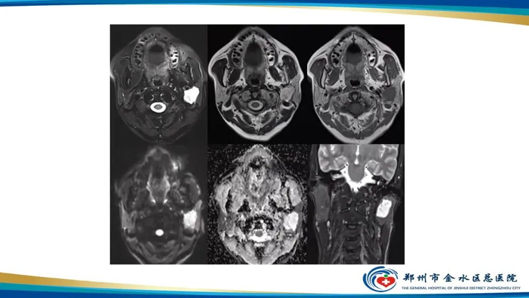 【病例】腮腺多形性腺瘤1例CT影像-22