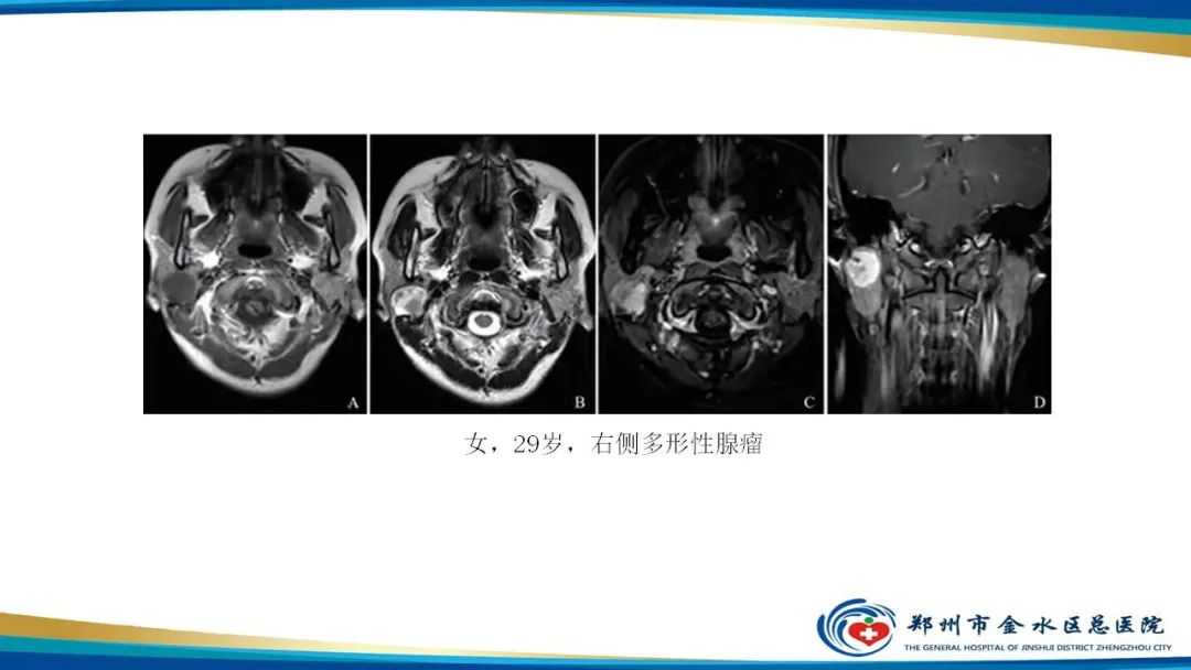 【病例】腮腺多形性腺瘤1例CT影像-21