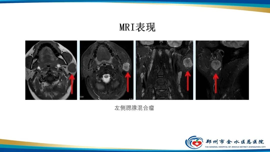 【病例】腮腺多形性腺瘤1例CT影像-23