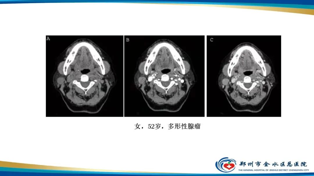 【病例】腮腺多形性腺瘤1例CT影像-18