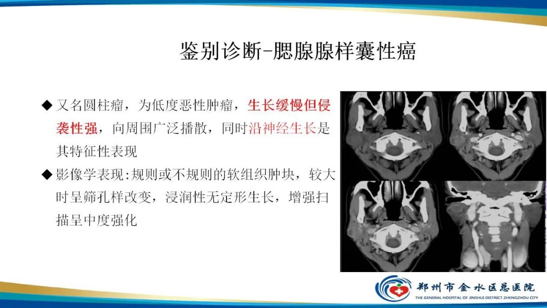 【病例】腮腺多形性腺瘤1例CT影像-28