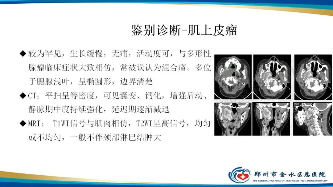 【病例】腮腺多形性腺瘤1例CT影像-26