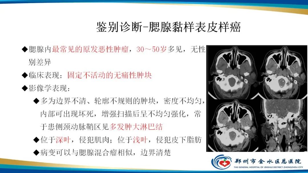 【病例】腮腺多形性腺瘤1例CT影像-27