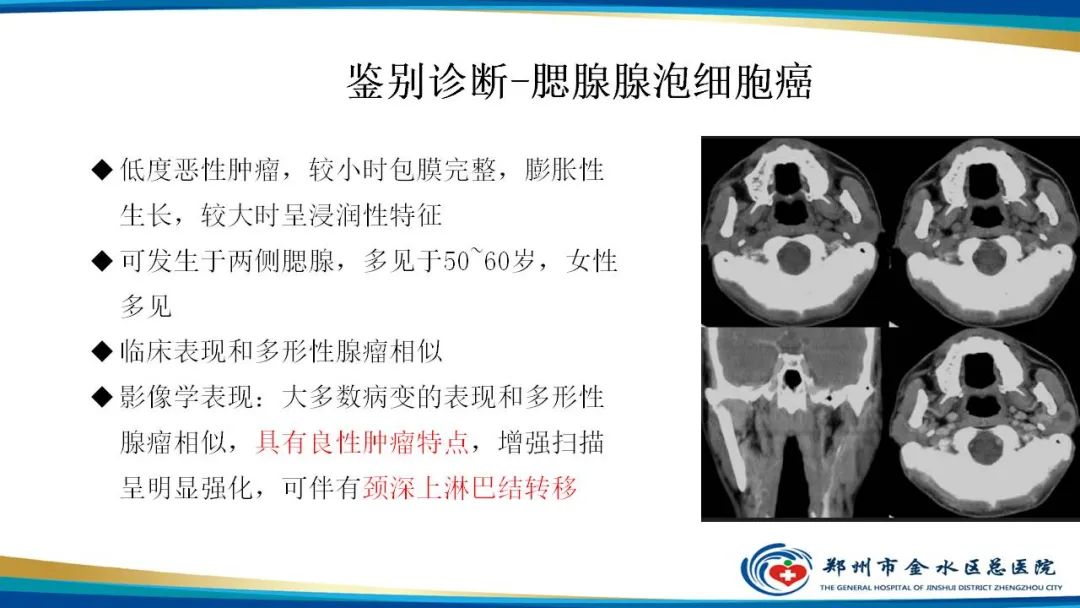 【病例】腮腺多形性腺瘤1例CT影像-29