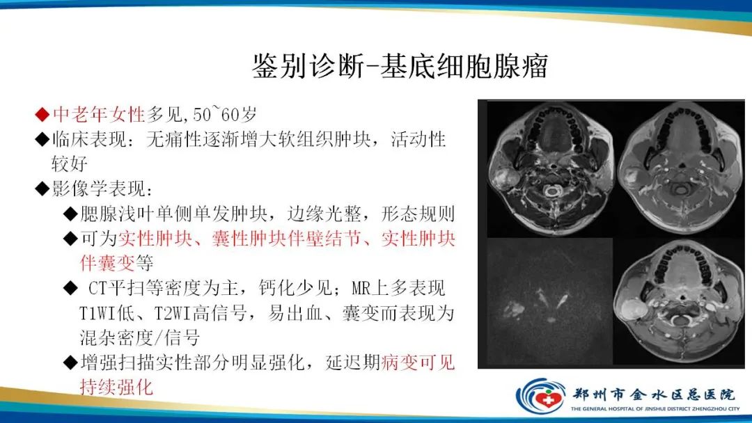 【病例】腮腺多形性腺瘤1例CT影像-25