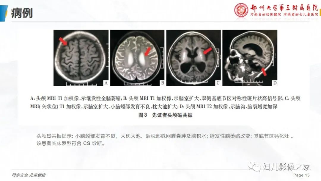 【病例】cockayne综合征1例影像诊断-15