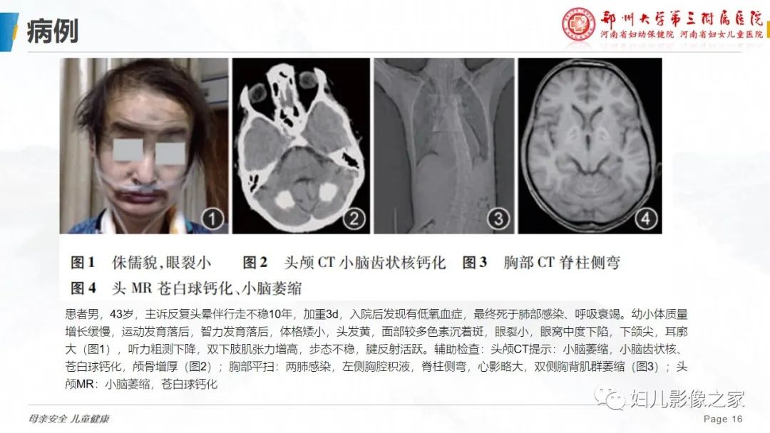 【病例】cockayne综合征1例影像诊断-16