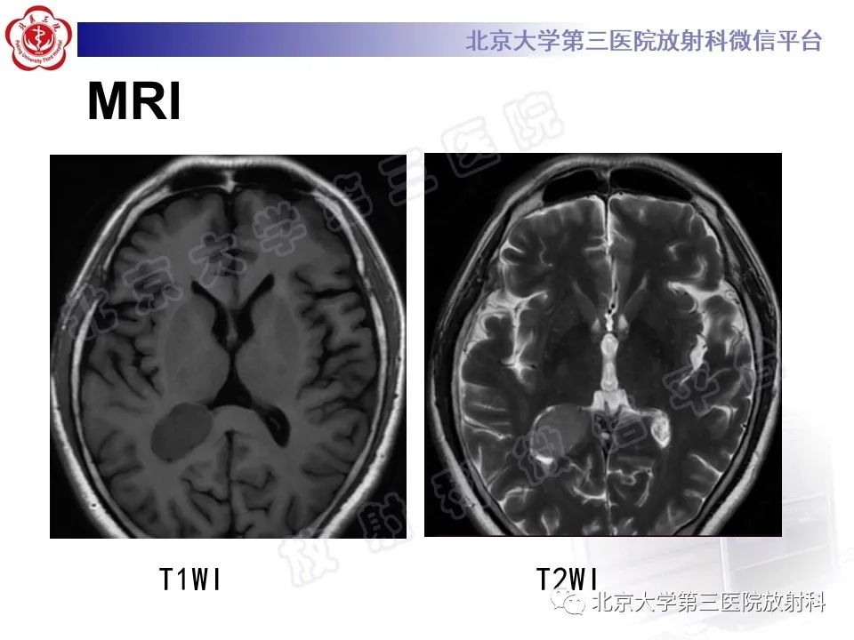 【PPT】脑室内脑膜瘤-3