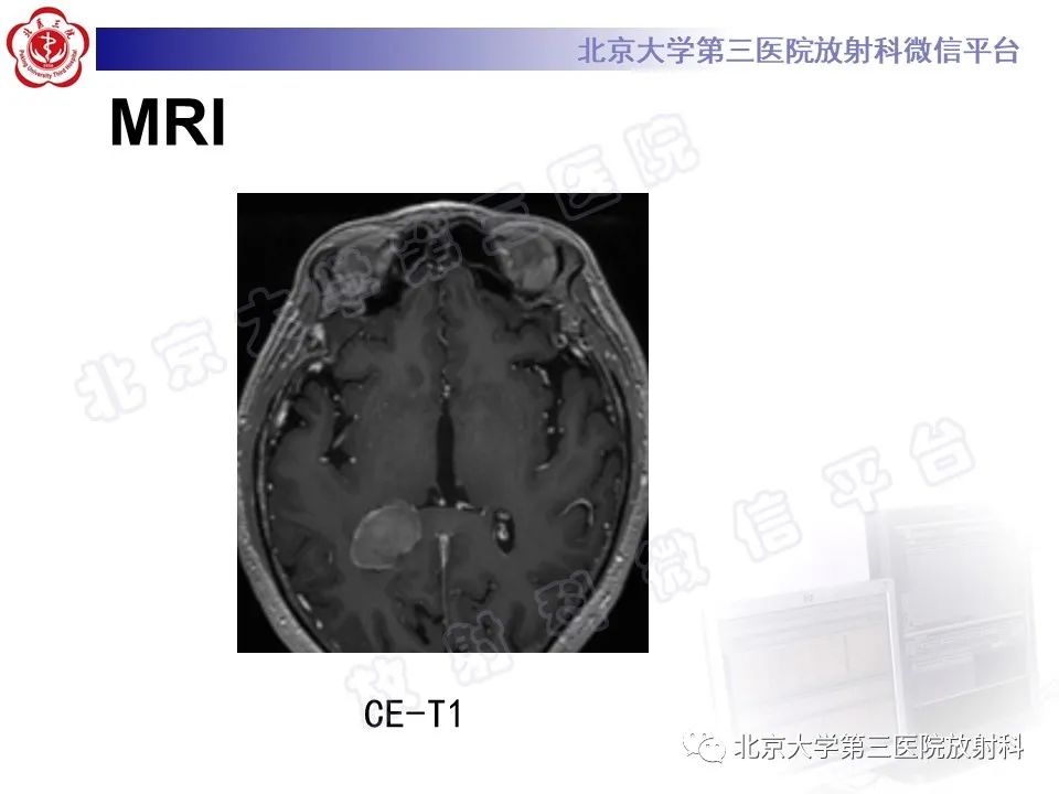【PPT】脑室内脑膜瘤-6