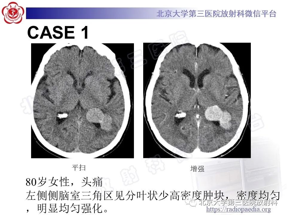【PPT】脑室内脑膜瘤-14