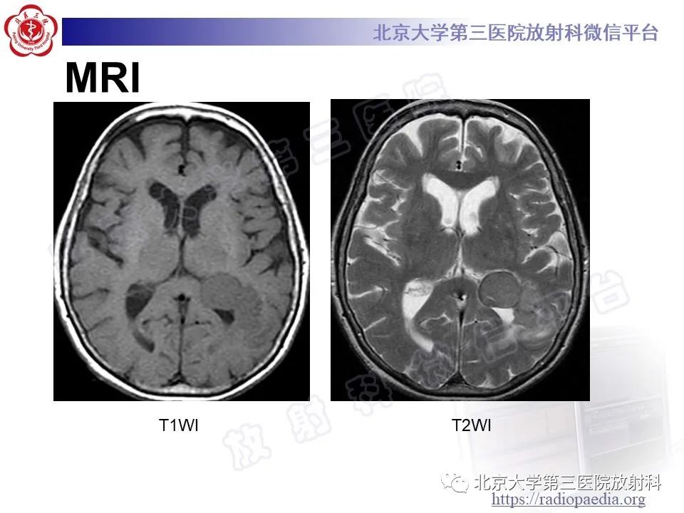 【PPT】脑室内脑膜瘤-15