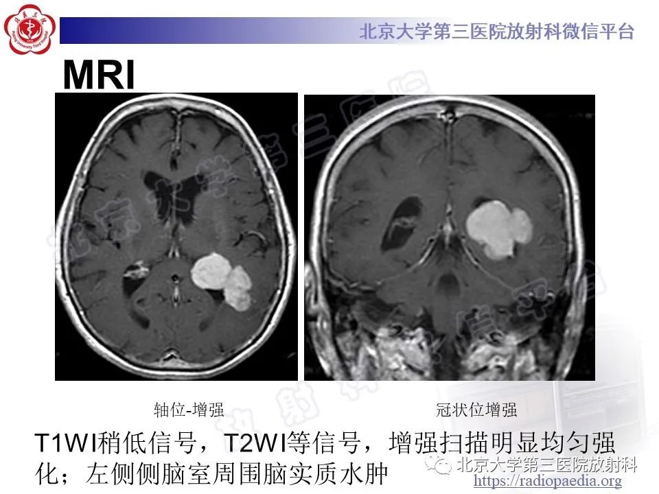 【PPT】脑室内脑膜瘤-16