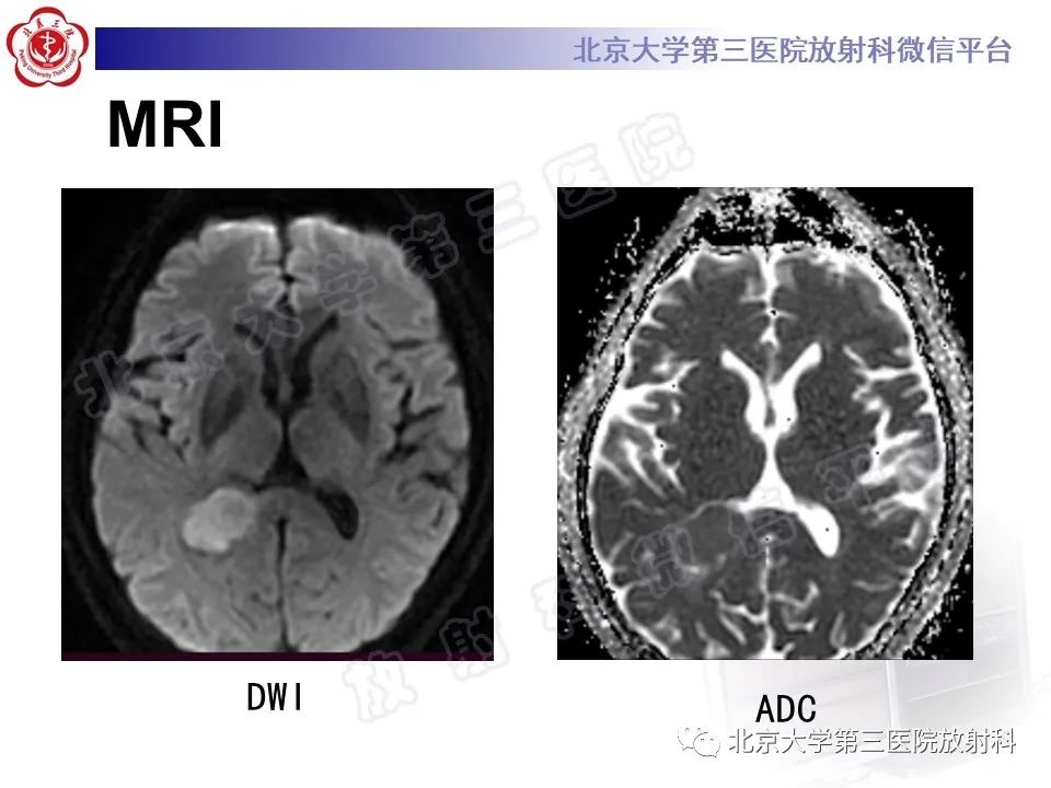 【PPT】脑室内脑膜瘤-4