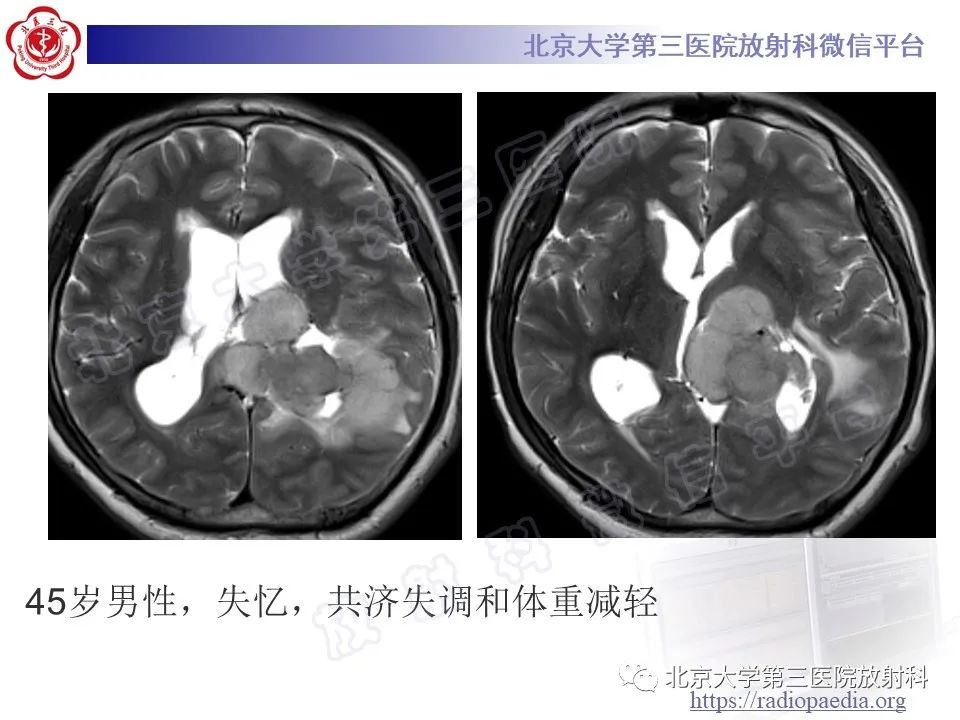 【PPT】脑室内脑膜瘤-20