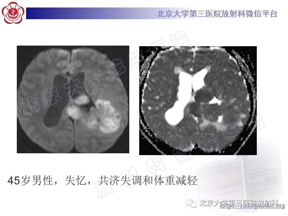 【PPT】脑室内脑膜瘤-21
