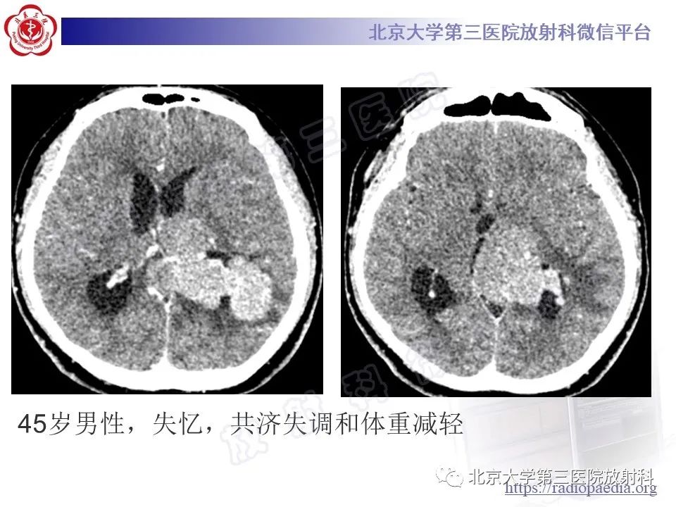 【PPT】脑室内脑膜瘤-18