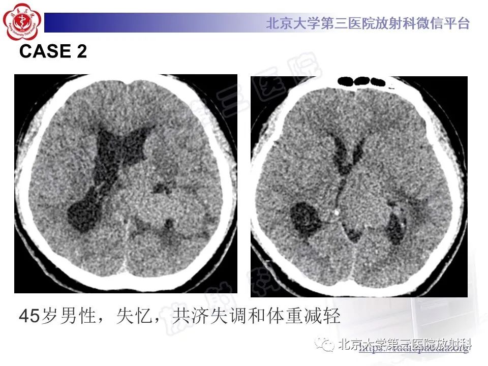 【PPT】脑室内脑膜瘤-17