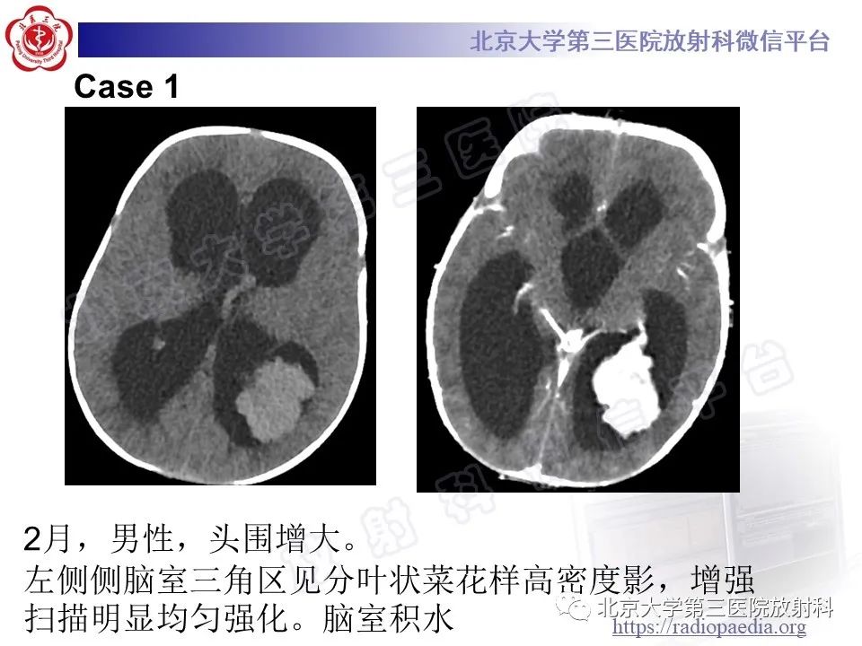 【PPT】脑室内脑膜瘤-30