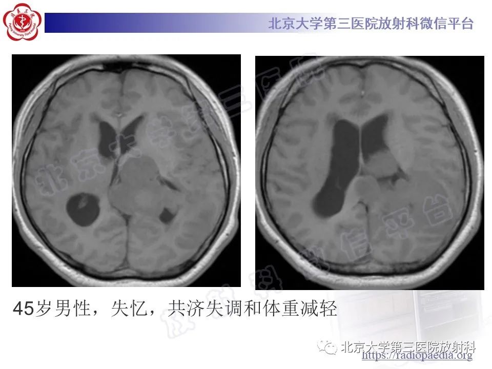 【PPT】脑室内脑膜瘤-19