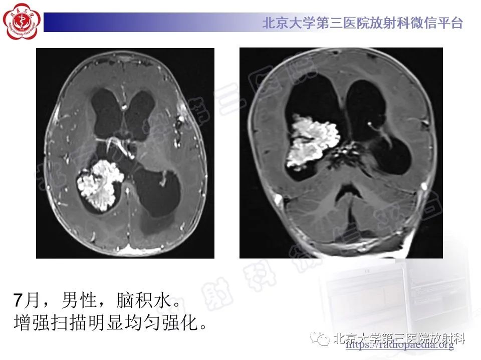 【PPT】脑室内脑膜瘤-32