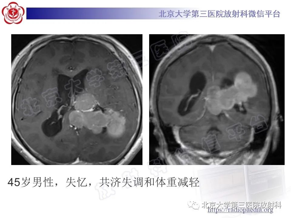 【PPT】脑室内脑膜瘤-22