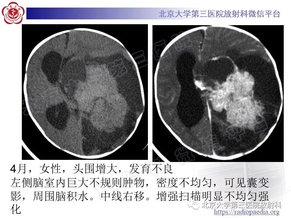 【PPT】脑室内脑膜瘤-35