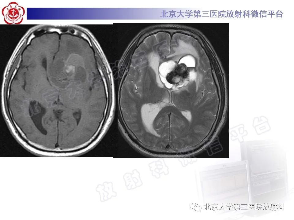 【PPT】脑室内脑膜瘤-42