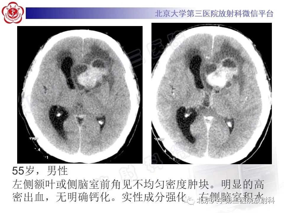 【PPT】脑室内脑膜瘤-41