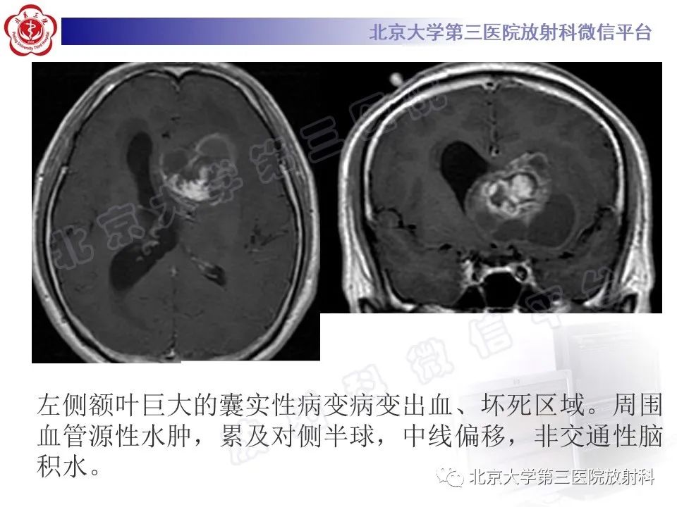 【PPT】脑室内脑膜瘤-43