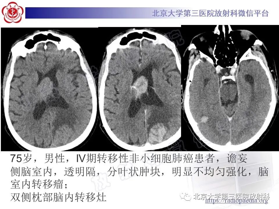 【PPT】脑室内脑膜瘤-45
