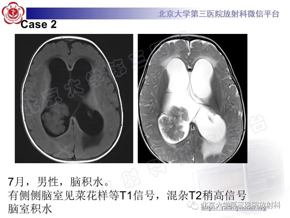 【PPT】脑室内脑膜瘤-31