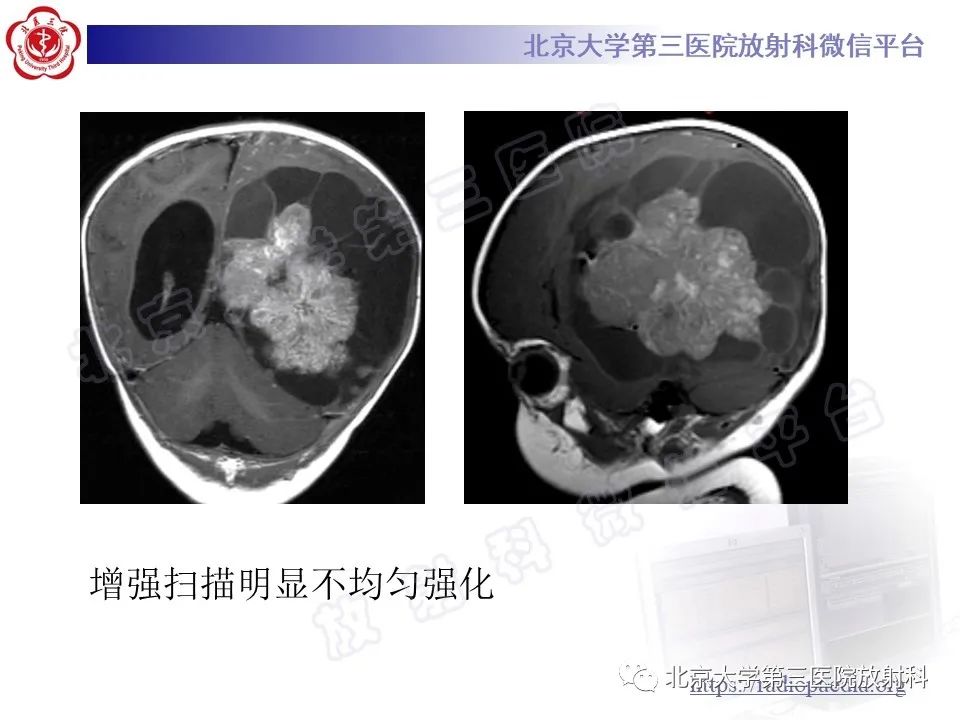 【PPT】脑室内脑膜瘤-37