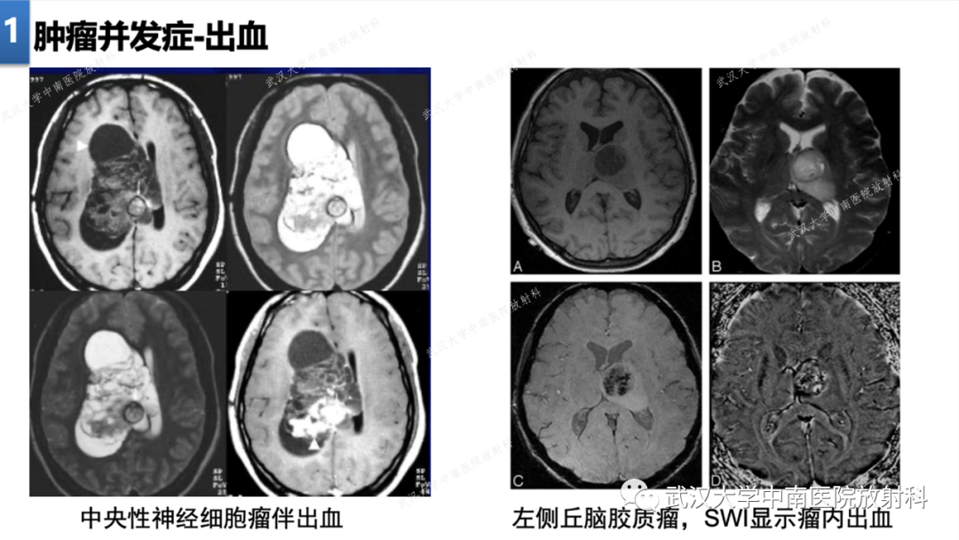 【PPT】局灶性脑部病变影像学诊断-8