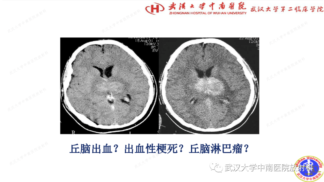 【PPT】局灶性脑部病变影像学诊断-2