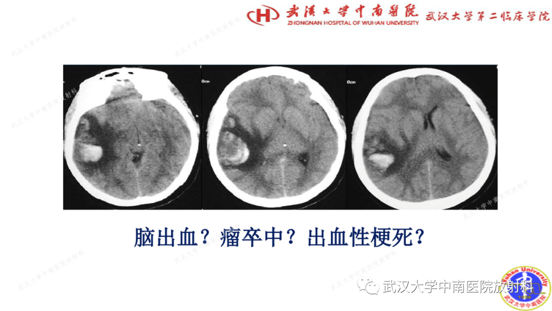 【PPT】局灶性脑部病变影像学诊断-3