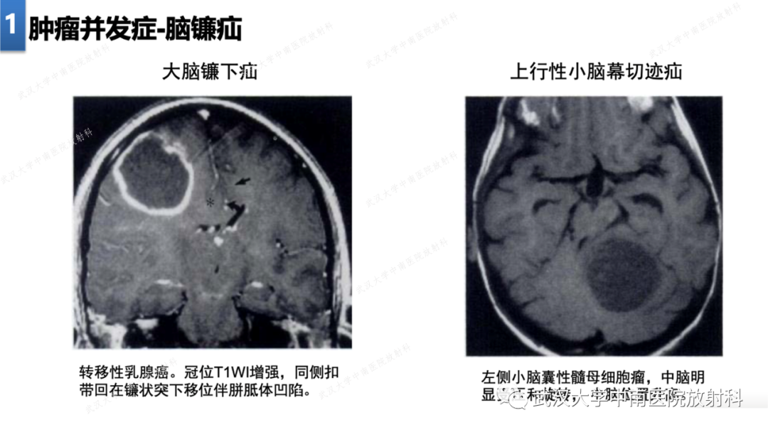 【PPT】局灶性脑部病变影像学诊断-9