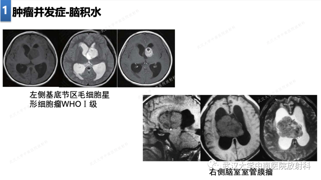 【PPT】局灶性脑部病变影像学诊断-10