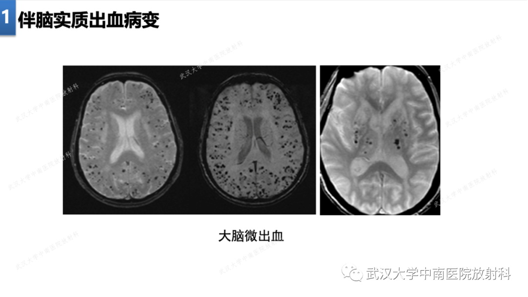 【PPT】局灶性脑部病变影像学诊断-12